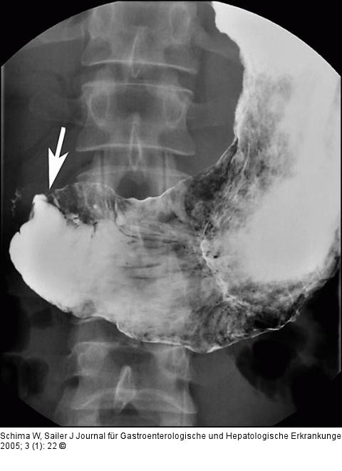 Morbus Crohn - Duodenum
