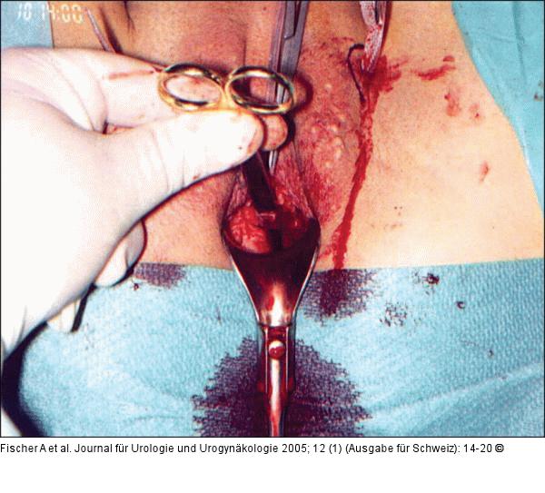Transobturatorielle Schlingensysteme - Operationstechnik