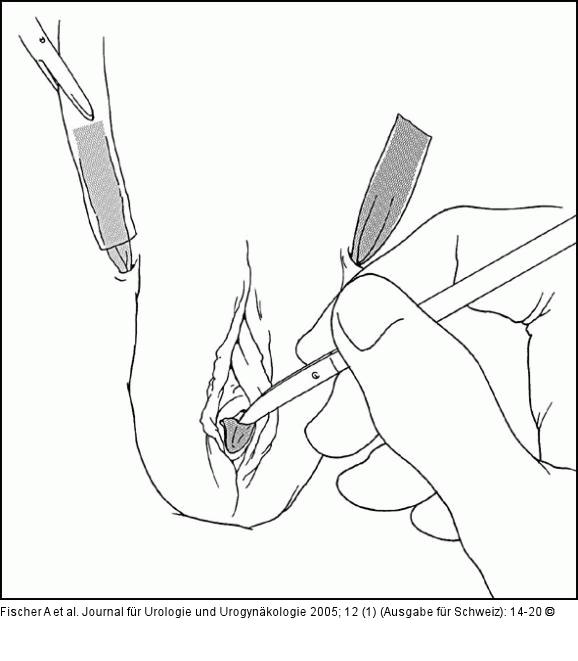 Transobturatorielle Schlingensysteme - Operationstechnik