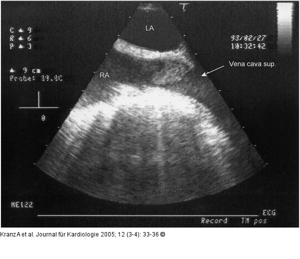 Vena cava sup. - Subtotale Thrombose