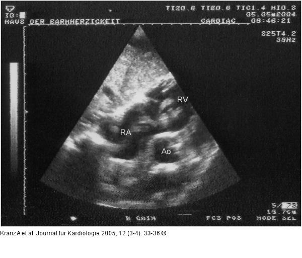 Flottierender Thrombus