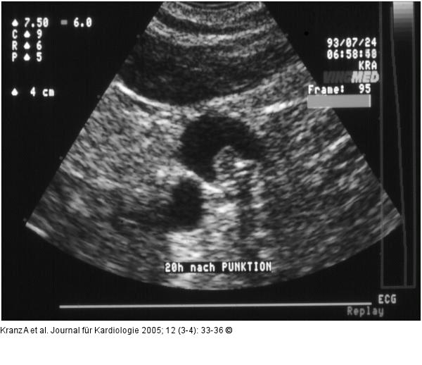 Katheterassoziierte Thrombose