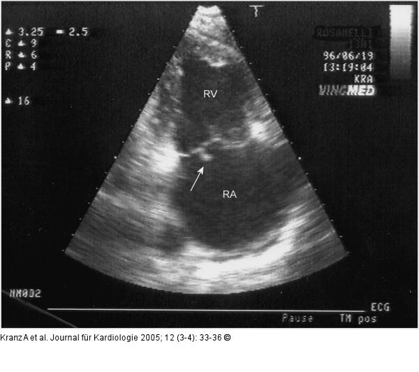 Endokarditis - Valv. tricuspidalis