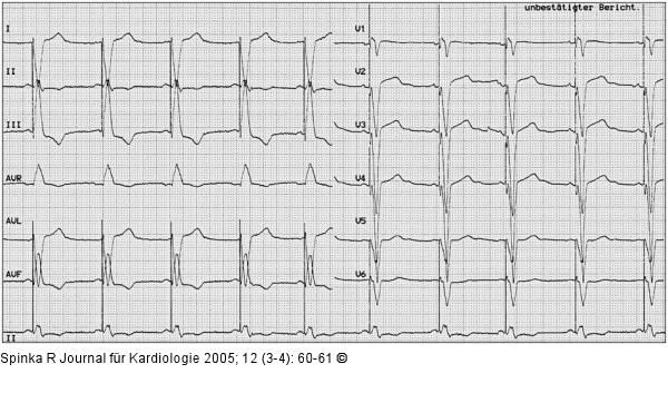 Intraventrikuläre Dyssynchronie