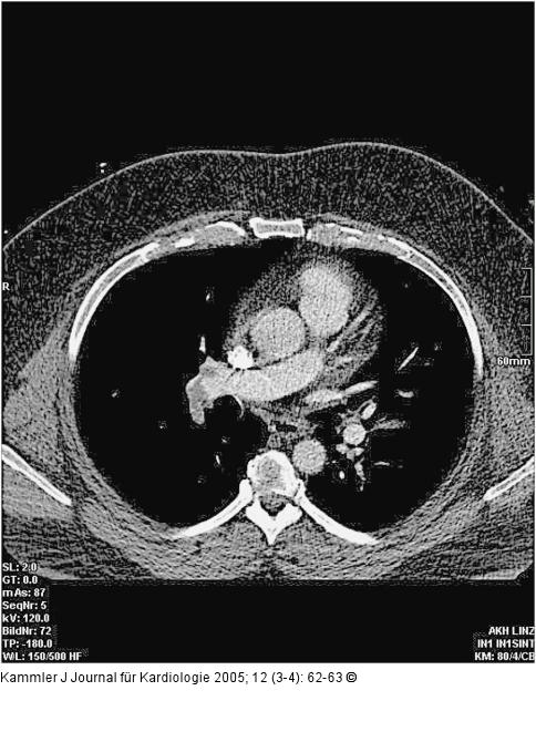 Zentrale Pulmonalembolie
