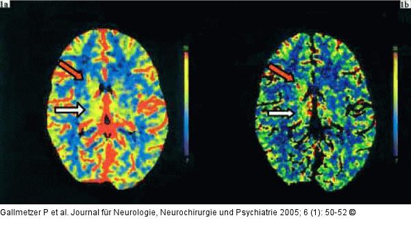 Basalganglien - Hyperperfusion