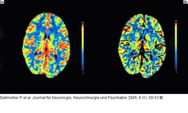 Hyperperfusion - Basalganglien