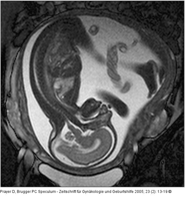 Pränatale Magnetresonanztomographie