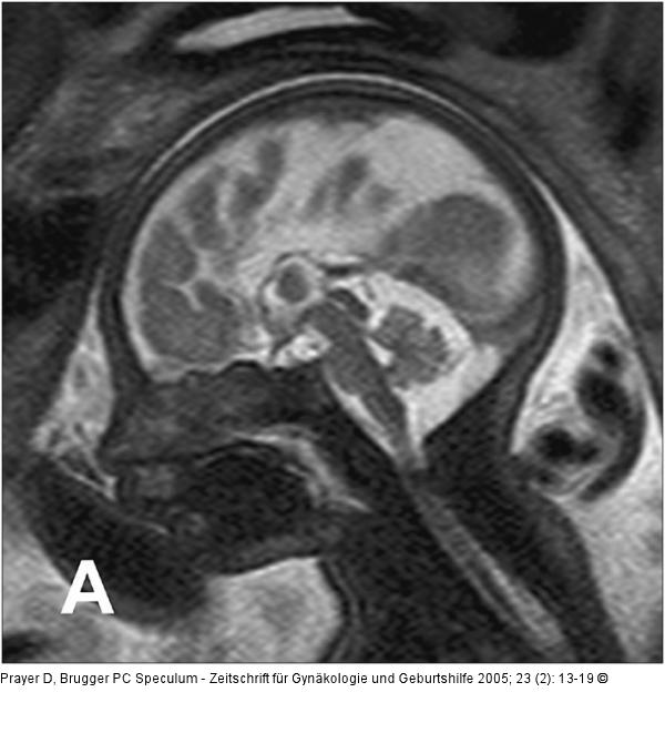 Pränatale Magnetresonanztomographie
