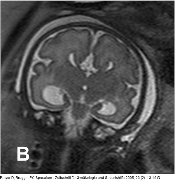 Pränatale Magnetresonanztomographie