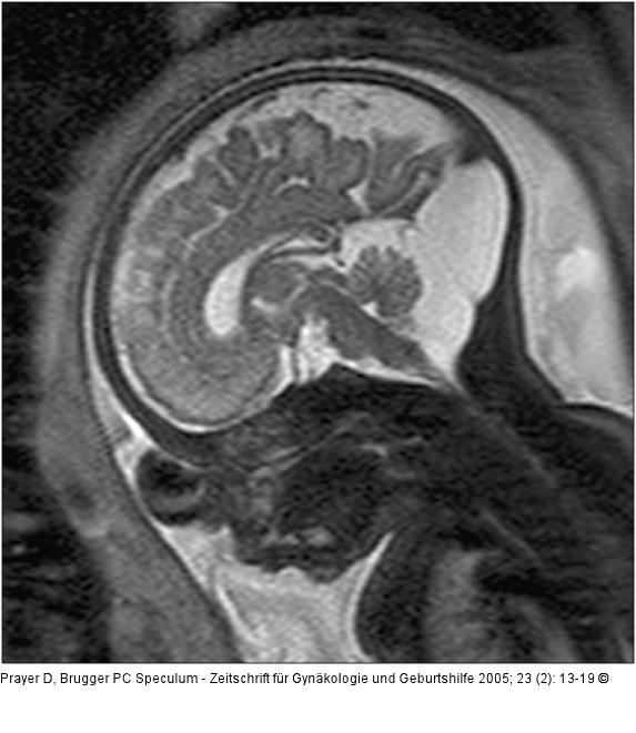 Pränatale Magnetresonanztomographie