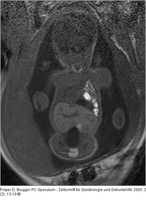 Pränatale Magnetresonanztomographie