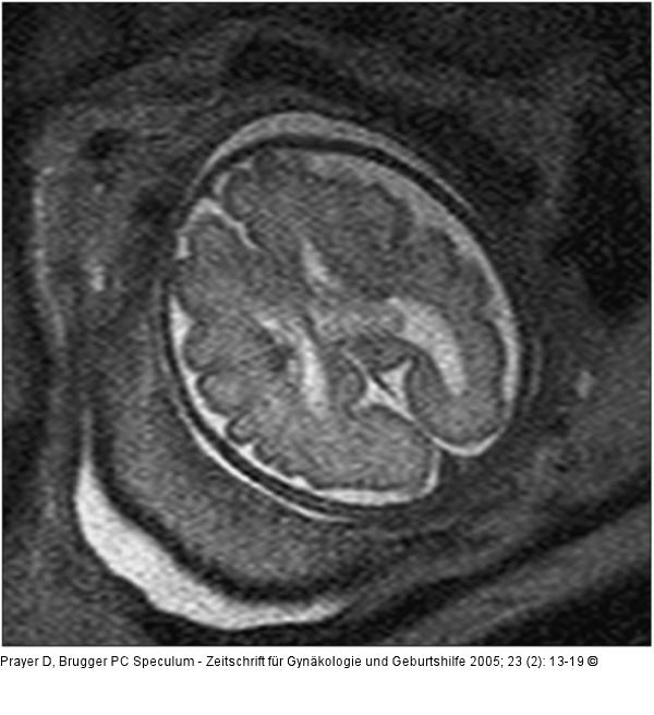 Pränatale Magnetresonanztomographie