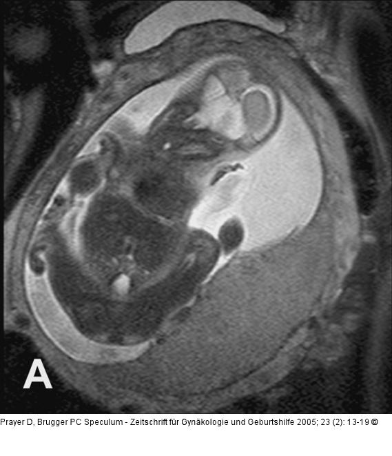 Pränatale Magnetresonanztomographie