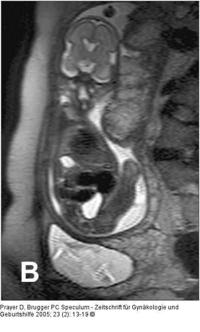 Pränatale Magnetresonanztomographie
