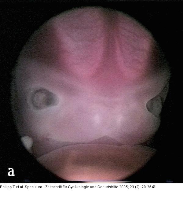Embryo - Gesicht - Obere Extremität