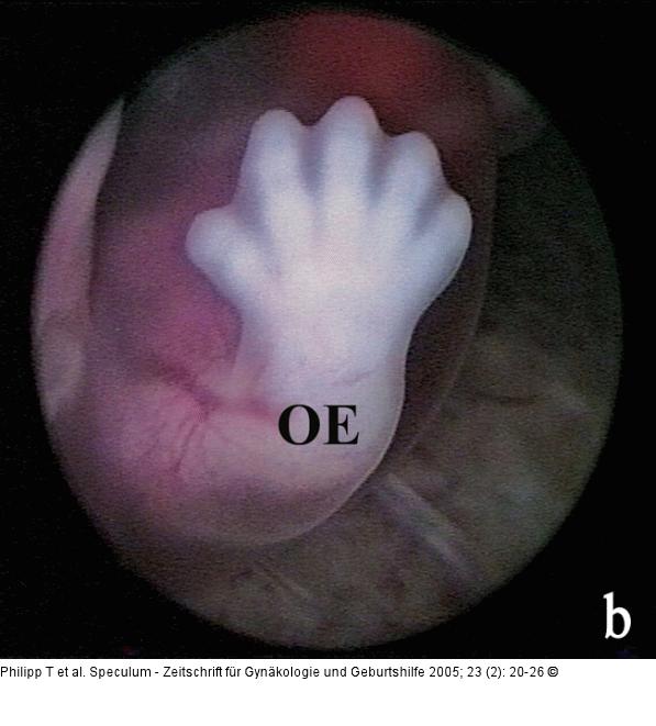 Embryo - Gesicht - Obere Extremität
