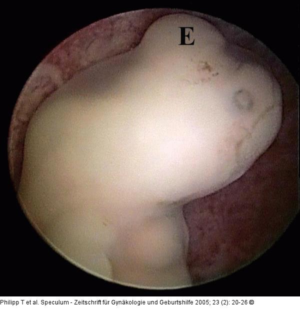 Embroy - Scheitel-Steißlage