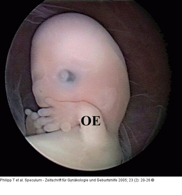 Mikrozephaler Embryo