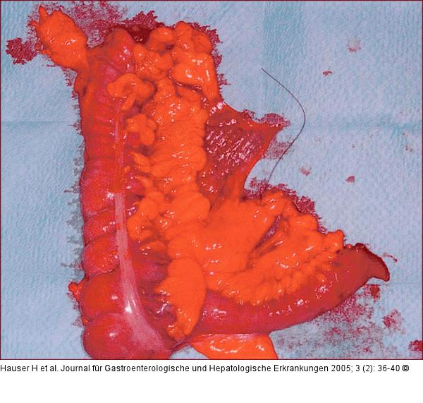 Hemikolektomie bei Karzinom im Bereich des Colon ascendens