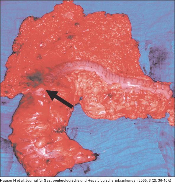 Kolektomie bei Karzinom im Bereich der Flexura coli dextra