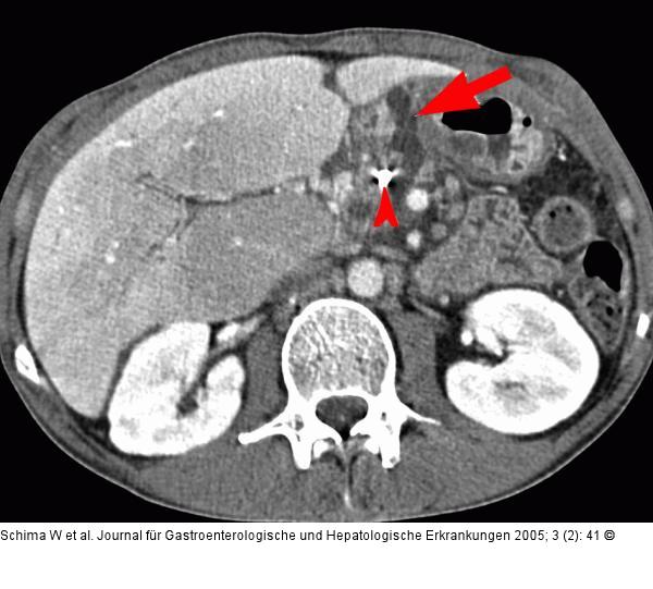 Plastikstent - Pankreasnekrose