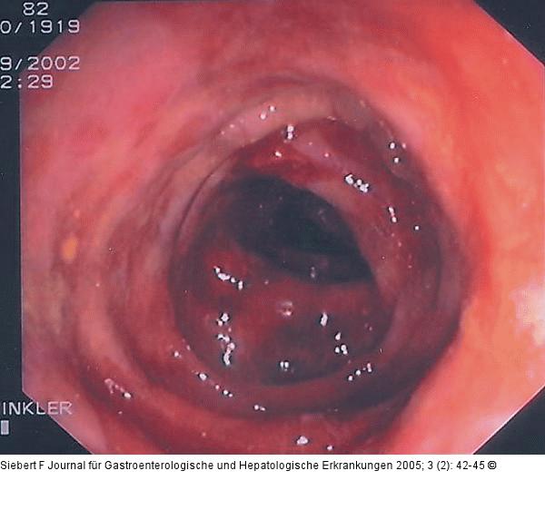 Kolon-Ischämie - Differentialdiagnosen