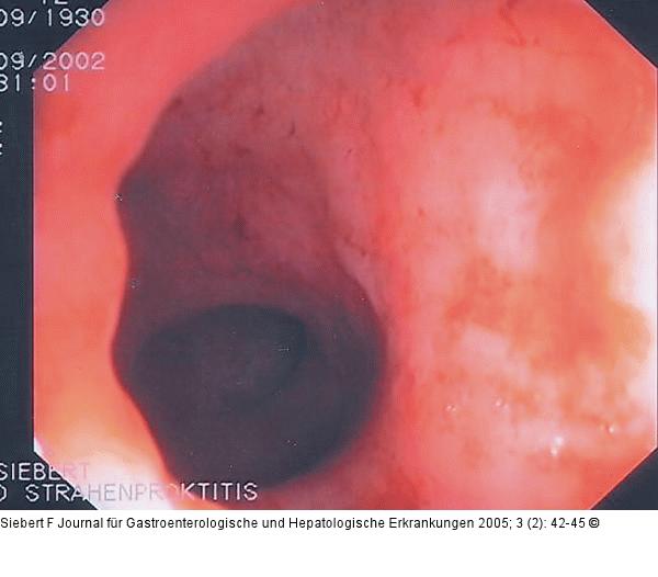 Kolon-Ischämie - Differentialdiagnosen