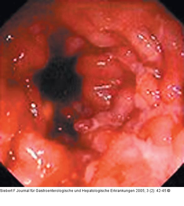 Kolon-Ischämie - Differentialdiagnosen