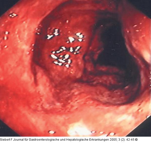 Kolon-Ischämie - Differentialdiagnosen
