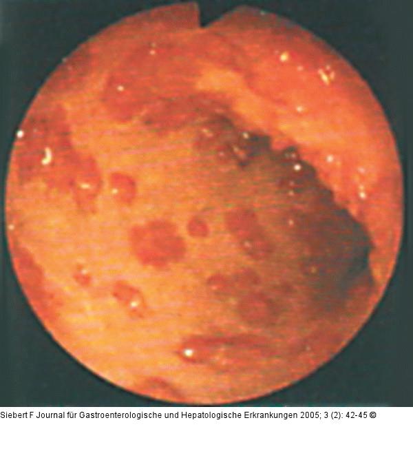 Kolon-Ischämie - Differentialdiagnosen