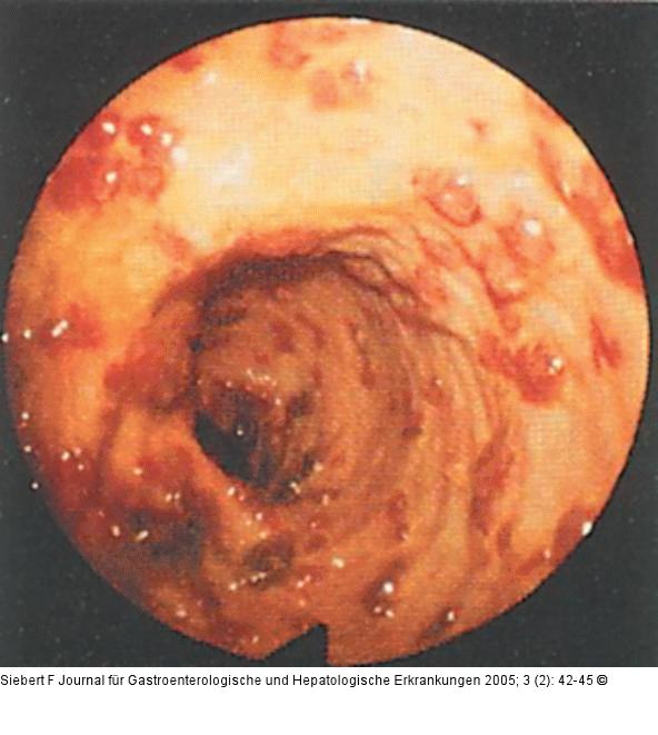 Kolon-Ischämie - Differentialdiagnosen