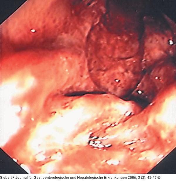 Kolon-Ischämie - Differentialdiagnosen