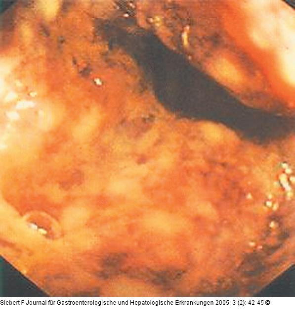 Kolon-Ischämie - Differentialdiagnosen