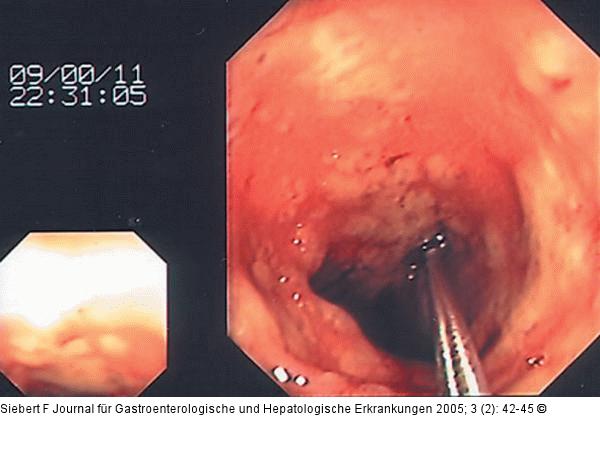 Kolon-Ischämie - Differentialdiagnosen