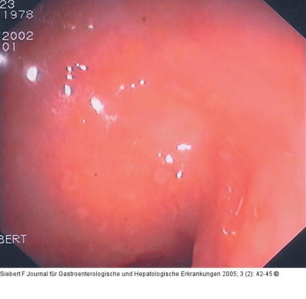 Kolon - Reaktionsmuster