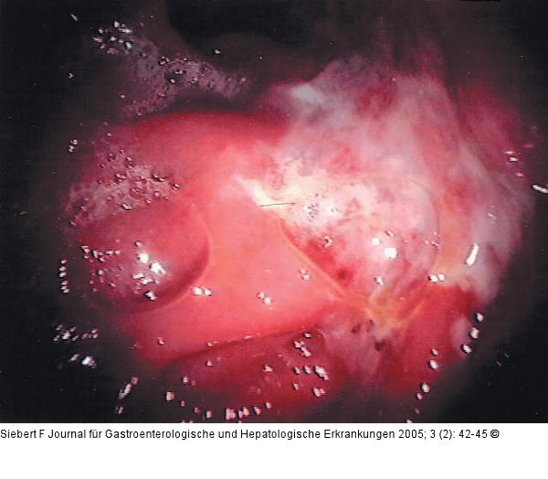 Kolon - Reaktionsmuster