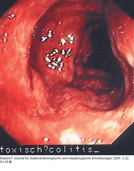 Kolon - Reaktionsmuster