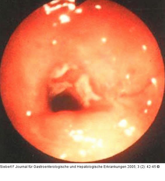 Kolon - Reaktionsmuster