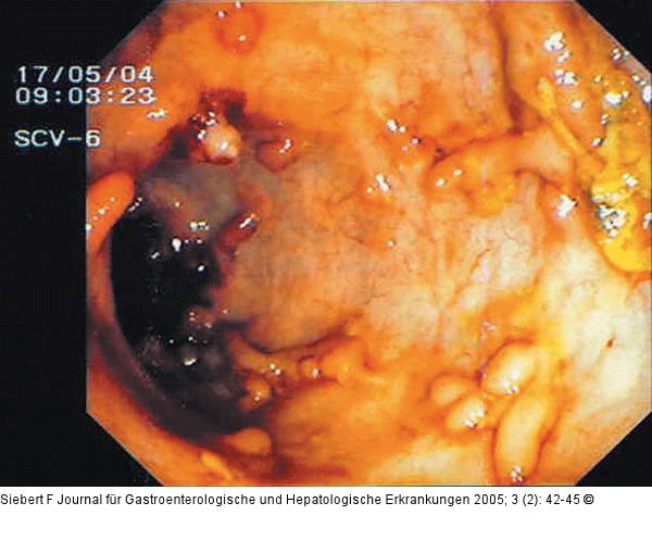 Kolon - Reaktionsmuster