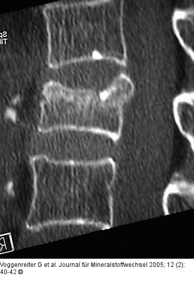 Wirbelkörperaufrichtung - postoperative Darstellung