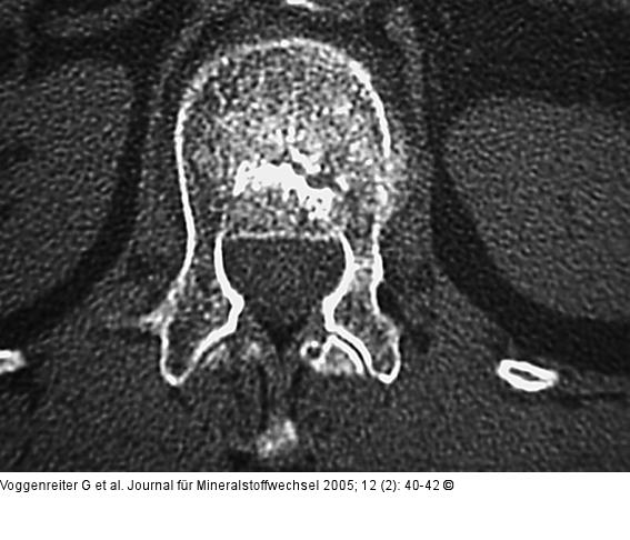 Wirbelkörperaufrichtung - postoperative Darstellung