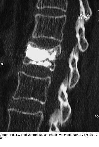 Wirbelkörperaufrichtung - postoperative Darstellung