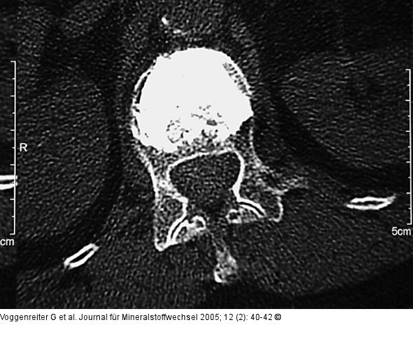 Wirbelkörperaufrichtung - postoperative Darstellung