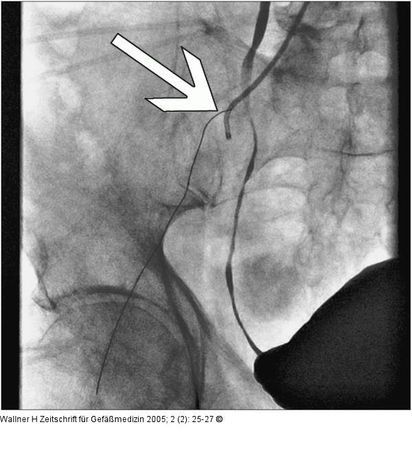 A. femoralis communis sin.