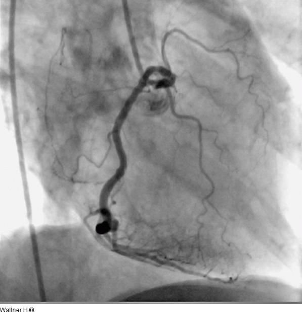 Perkutane koronare Intervention