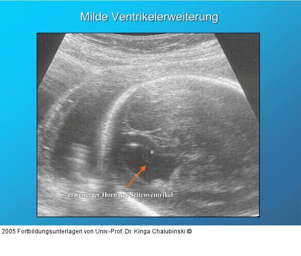 Milde Ventrikelerweiterung