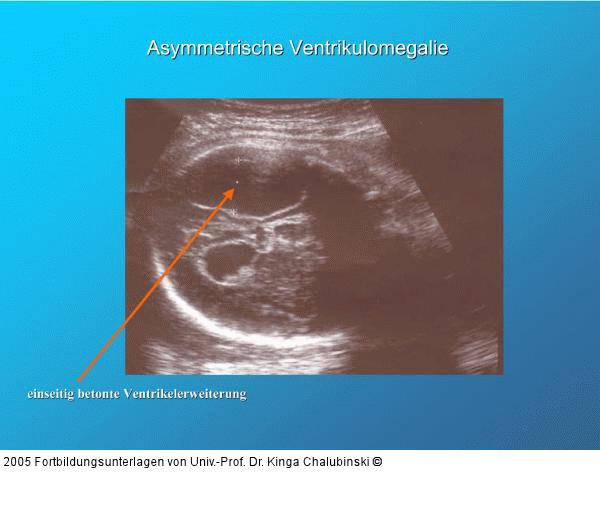Asymmetrische Ventrikulomegalie