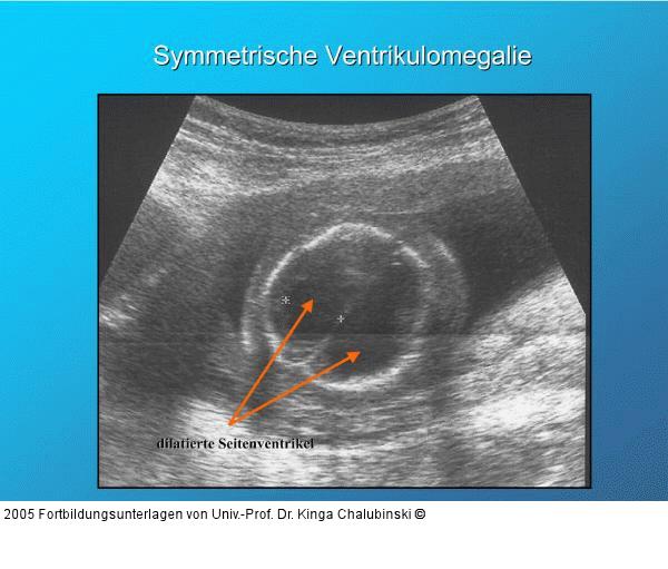 Symmetrische Ventrikulomegalie