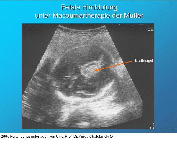 Fetale Hirnblutung unter Macoumartherapie der Mutter